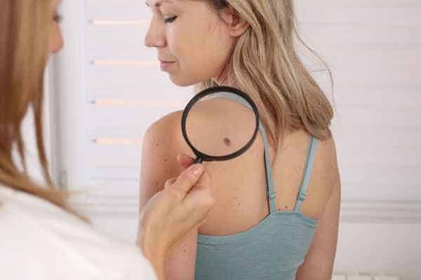 What Are Traditional Skin Lesion Removal Methods Wiltshire?