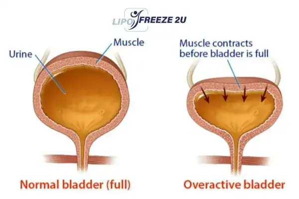 diagram of overactive bladder treatment Wiltshire