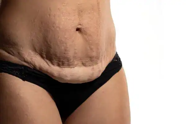 loose skin after weight loss injections Wiltshire