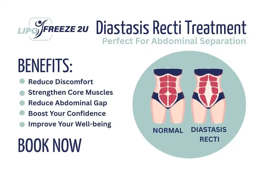 Benefits of body toning treatment Wiltshire for Diastasis recti