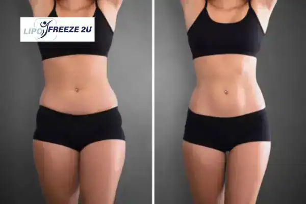 How Can LIPO FREEZE 2U Support Your Post-Pregnancy Body Recovery Wiltshire?