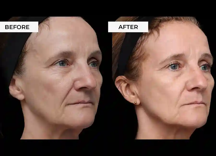 How Many RF Microneedling Sessions Will You Need to See a Difference Wiltshire?