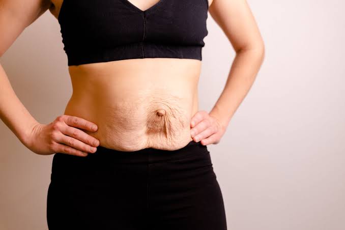 Is Surgery Really the Only Way to Repair Diastasis Recti Wiltshire?