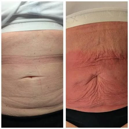 How Does RF Microneedling Improve Crepey, Thin and Uneven Skin Texture Wiltshire?
