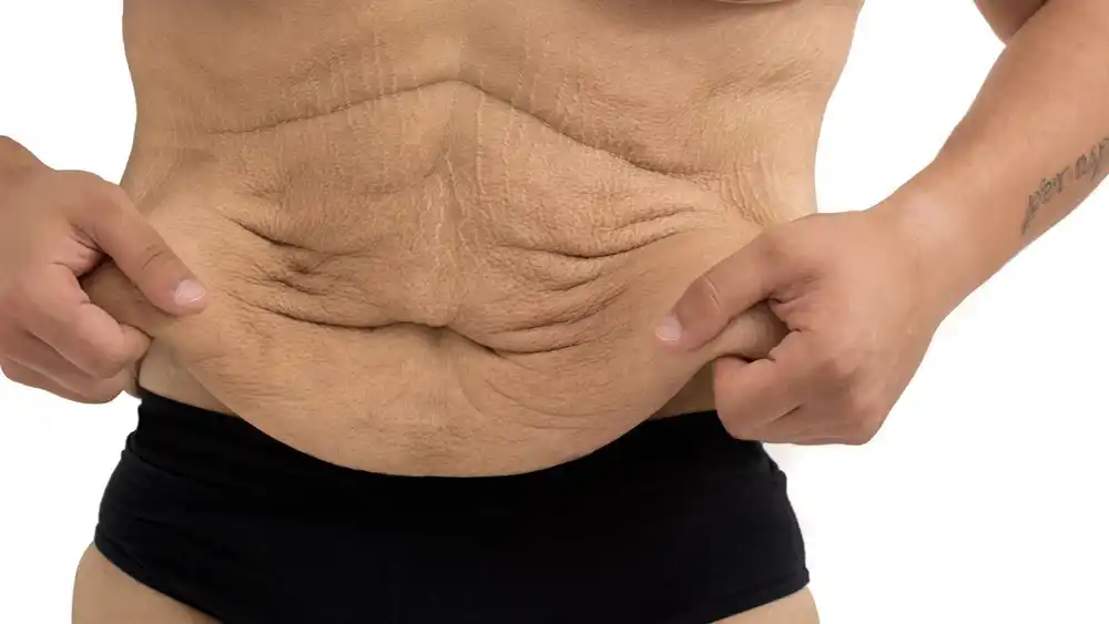 RF Microneedling for Loose Skin: How Can It Help Tighten and Reshape the Skin Wiltshire?